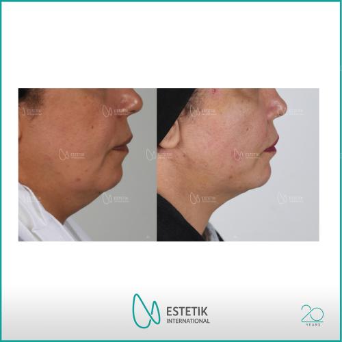 Estiramiento facial no quirúrgico Fotos del antes y el después